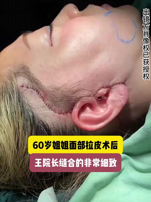 八大处杨欣做拉皮手术怎么样？杨欣做面部微创悬吊提升术技术好(图1)